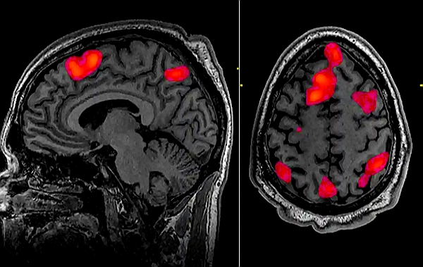 Umělá inteligence (AI) a čtení myšlenek díky magnetické rezonanci - Dekodér by mohl rekonstruovat řeč pomocí dat skenování fMRI